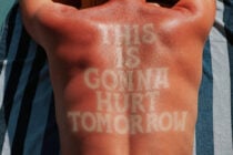 Chest sunburn with faded white text tan lines from sun exposure